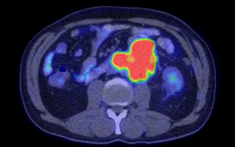 Tumoră cancerigenă