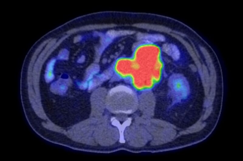 Tumoră cancerigenă