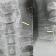 Primul implant la nivelul măduvei spinării din lume va fi realizat în Israel și ar putea permite pacienților să meargă din nou