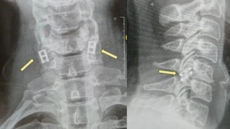 Primul implant la nivelul măduvei spinării din lume va fi realizat în Israel și ar putea permite pacienților să meargă din nou