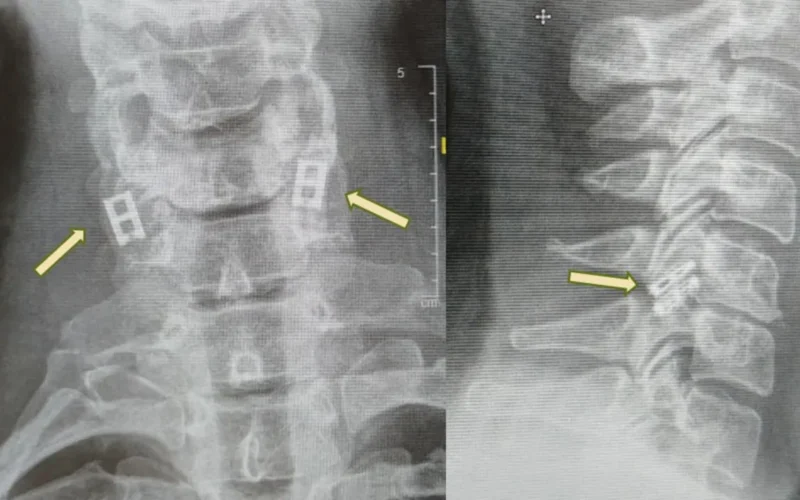 Primul implant la nivelul măduvei spinării din lume va fi realizat în Israel și ar putea permite pacienților să meargă din nou